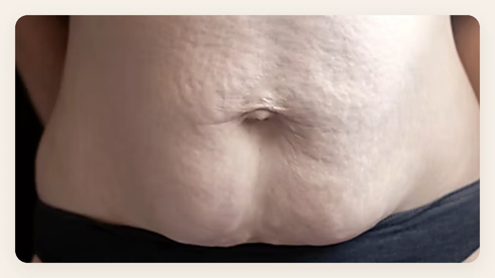 Real postpartum abdomen showing loose skin, stretch marks and abdominal separation after childbirth