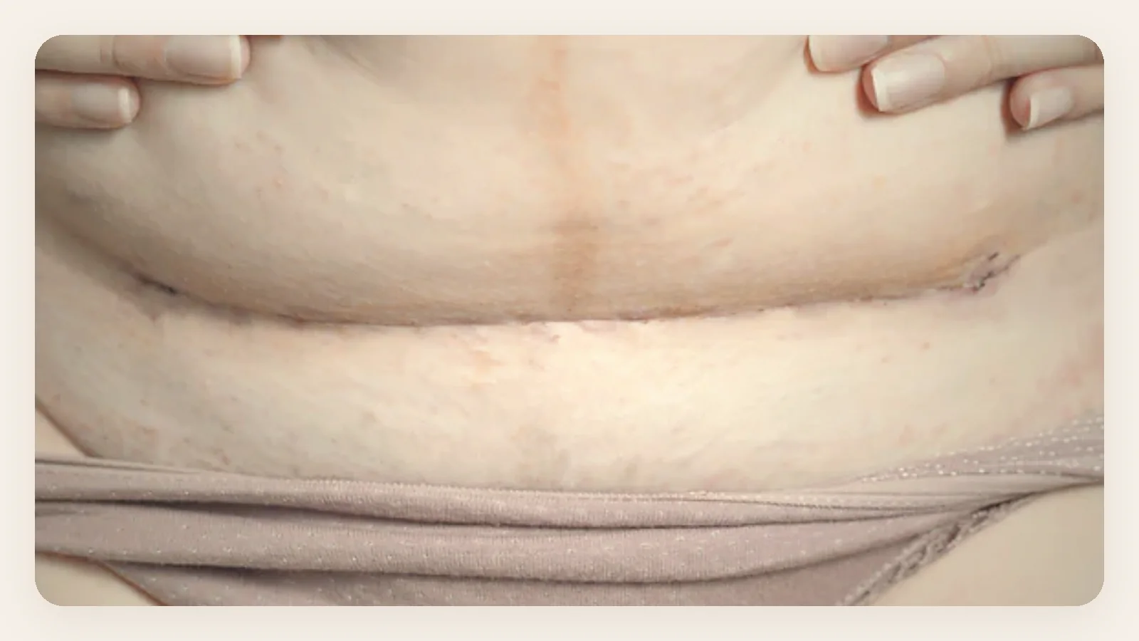 C-Section Recovery Timeline, Week by Week for Indian Mothers