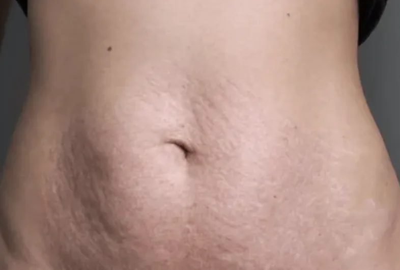 Close-up of a real postpartum belly with stretch marks and loose skin around the navel