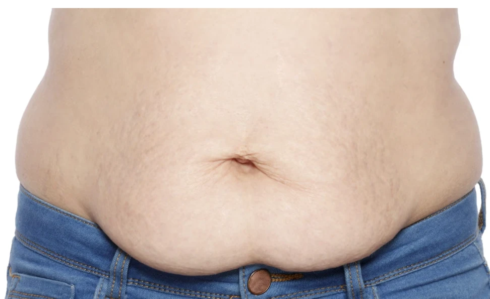 A postpartum belly, real and unretouched