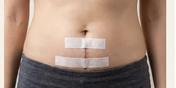 A real C-section incision on day 2, covered with surgical tape dressing
