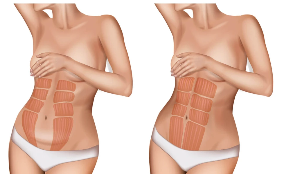 Diagram comparing normal abdominal muscles to a separated diastasis recti gap