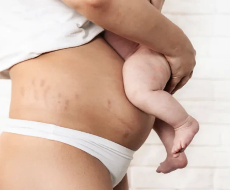 Back Pain After a C-Section: Why It Happens and What Actually Helps