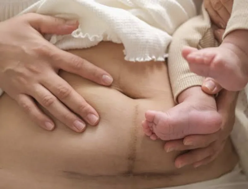 C-Section Scar Massage, The Complete How-To Guide